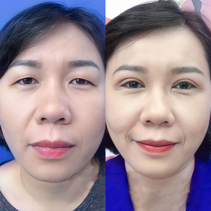 Trẻ hóa đôi mắt đến 5 tuổi chỉ sau 30 phút thực hiện