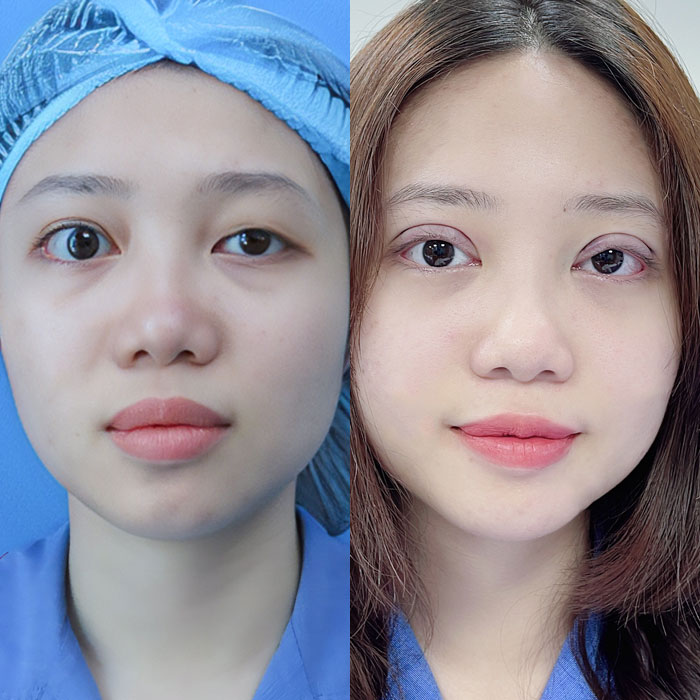 Chỉnh hình sụp mí – Giải pháp “tái sinh” đôi mắt chỉ sau 30 phút