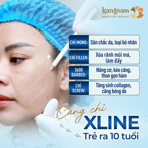 Căng chỉ Xline là giải pháp làm đẹp hàng đầu tại Kangnam