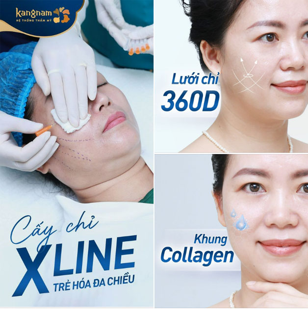 Căng chỉ Xline giúp da căng bóng, tăng sinh collagen