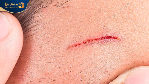 Có thể gây tổn thương cho da nếu cạo lông mặt sai cách