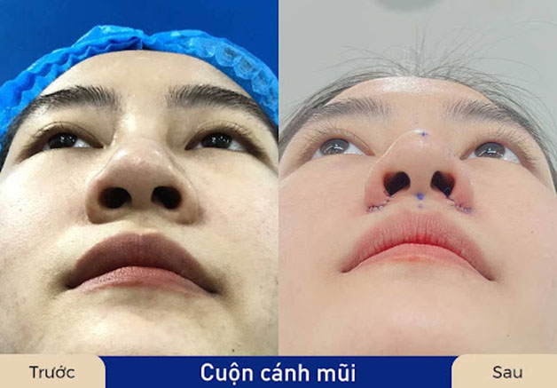 Cuộn cánh mũi là phương pháp thẩm mỹ phù hợp với người có phần da mũi mỏng
