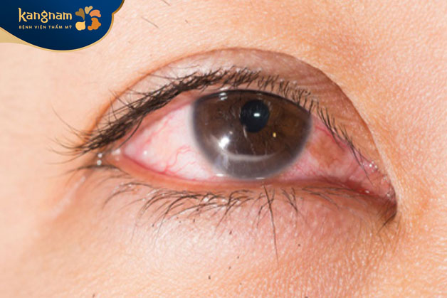 Khóe mắt thường bị dị ứng bởi một số yếu tố như lông động vật, phấn hoa, bụi mịn