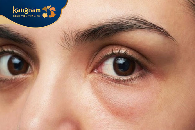Hốc mắt sâu là tình trạng các vùng hốc mắt ở giữa lông mày và mí mắt trên bị lõm sâu