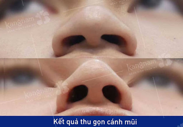 Thu nhỏ cánh mũi tạo hiệu ứng đẩy sống mũi lên ca, mang lại dáng mũi thon gọn