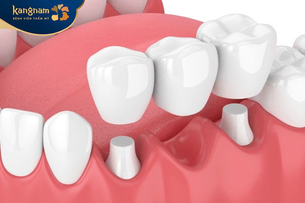 Phương pháp làm cầu răng sứ áp dụng khi một hoặc vài chiếc răng bị mất