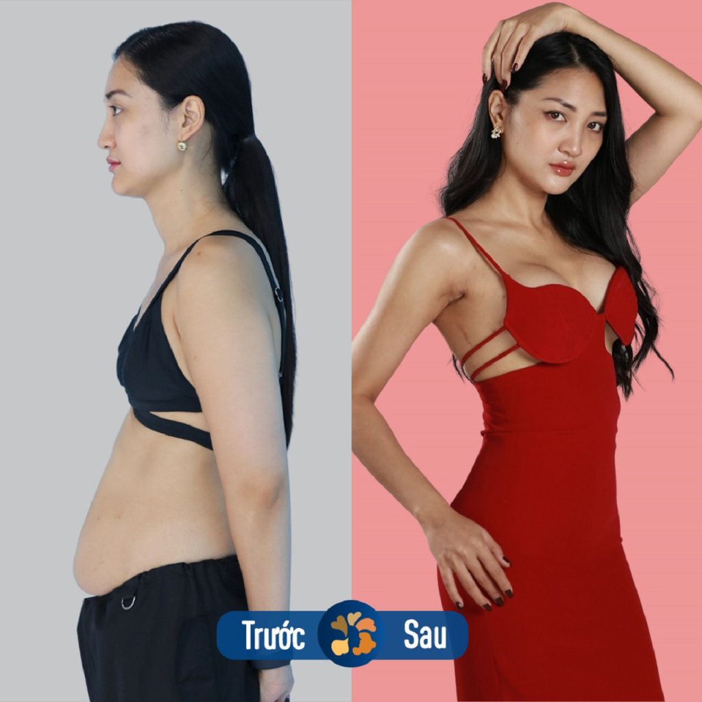 Giảm mỡ tại Kangnam kiến tạo vòng eo thon gọn, vóc dáng chuẩn đẹp