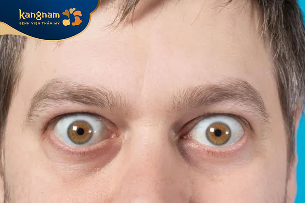 Hiện tượng lồi mắt có thể thay đổi tùy vào mức độ lồi