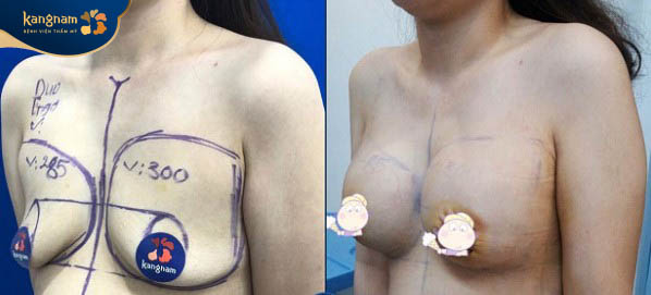 Hình ảnh trước và sau khi nâng ngực tại kangnam