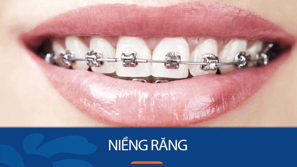 Niềng răng mang lại lợi ích gì? Phương pháp niềng răng mới