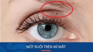Đặc điểm của nốt ruồi trên mí mắt? Xem tướng nốt ruồi nam và nữ