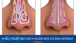 Giải đáp: Phẫu thuật vẹo vách ngăn mũi có đau không