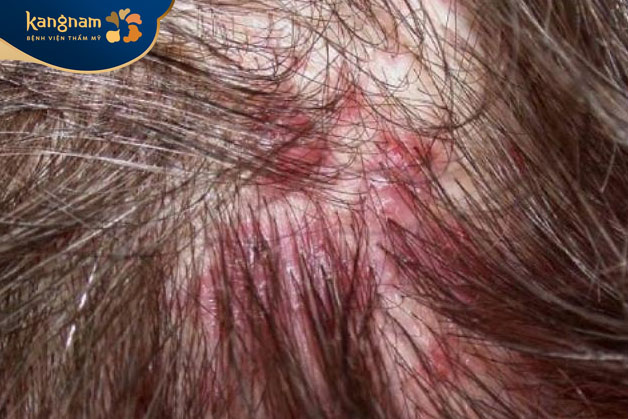 Nguyên nhân chủ yếu của tình trạng viêm nang tóc thường do tụ cầu vàng