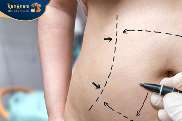 Phẫu thuật tạo hình bụng là ca phẫu thuật cắt bỏ da, mỡ thừa (da bị nhăn nheo, giãn, vết rạn, có sẹo) ở vùng bụng