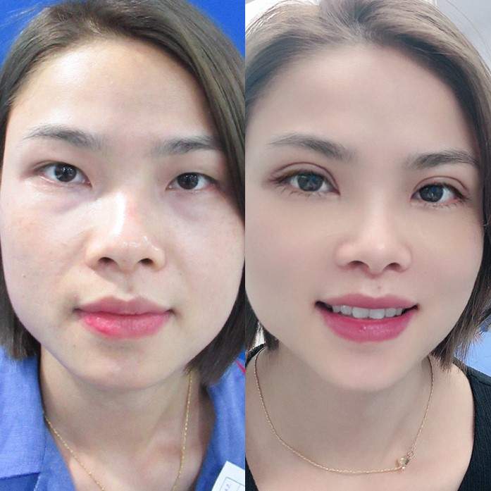 Cắt mí – Tạo mắt 2 mí đẹp chuẩn hàn tại Chuyên khoa Mắt Kangnam