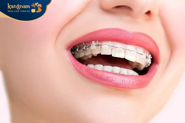 Niềng chỉnh nha mang lại nhiều lợi ích cho sức khỏe răng miệng
