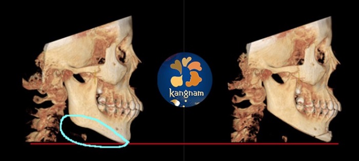 Thu gọn góc hàm Vline sử dụng kỹ thuật phẫu thuật cắt chỉnh xương góc hàm tân tiến nhất của Hàn Quốc