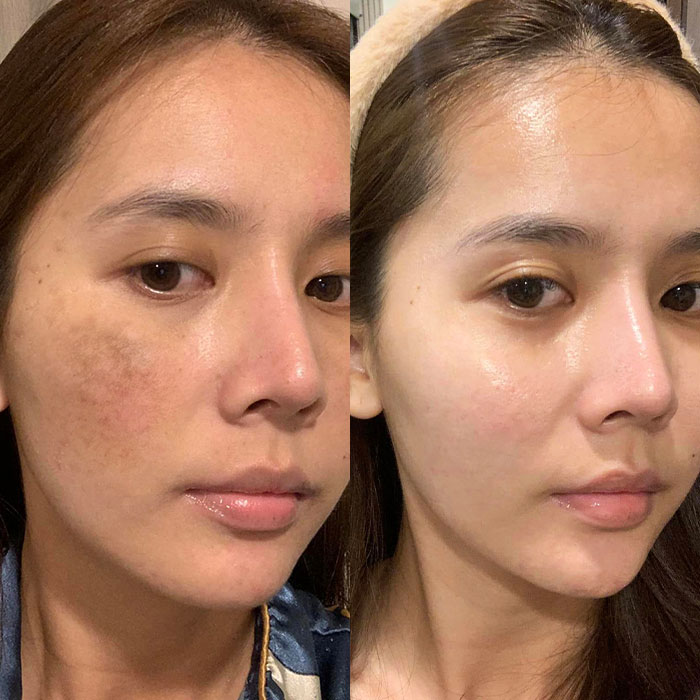 Điều trị nám, tàn nhang hiệu quả với công nghệ Laser Top 1 thế giới