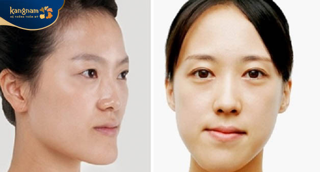 Mặt lệch, mất cân xứng sau tiêm botox