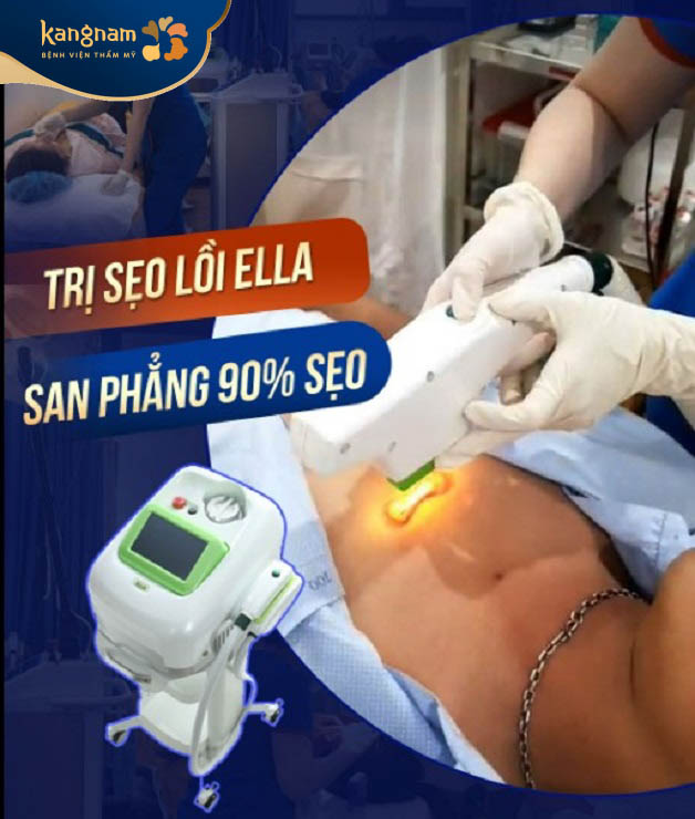 Dịch vụ điều trị sẹo lồi tại Kangnam ứng dụng công nghệ ELLA hiện đại