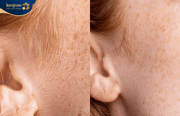Phương pháp triệt lông vùng mặt giúp loại bỏ các sợi lông rậm rạp