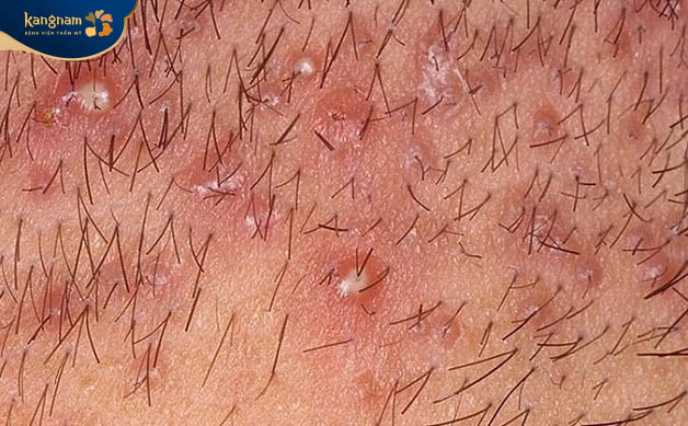 Triệu chứng viêm nang lông ở vùng kín nam giới