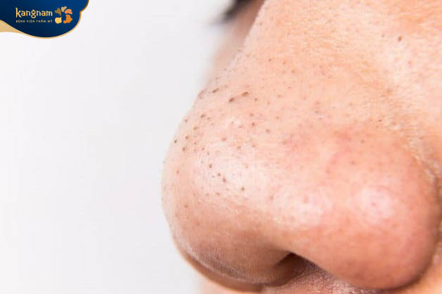 Mụn đầu đen ở mũi gây ra nhiều ảnh hưởng