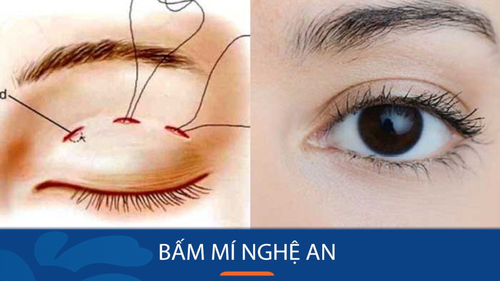 Bấm mí Nghệ An – Tạo nếp mí tự nhiên cho đôi mắt to tròn