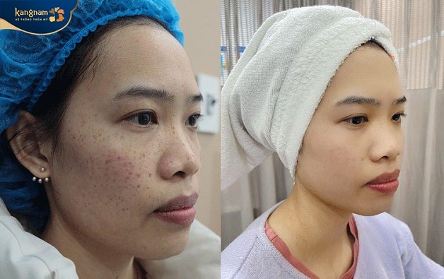 Sau 2 buổi điều trị tàn nhang tại Kangnam, da của khách hàng đã sáng, đều màu hơn
