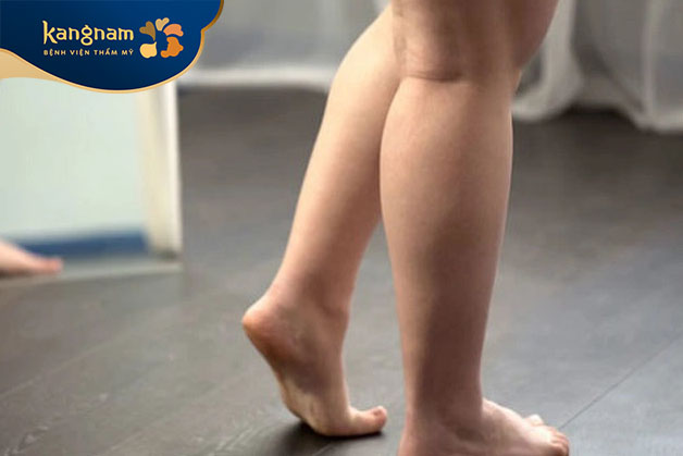 Giảm mỡ bắp chân giúp đôi chân thon gọn hơn
