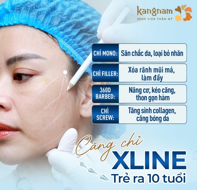 Căng chỉ Xline hiện là dịch vụ căng chỉ được ưa chuộng nhất tại Kangnam Hải Phòng