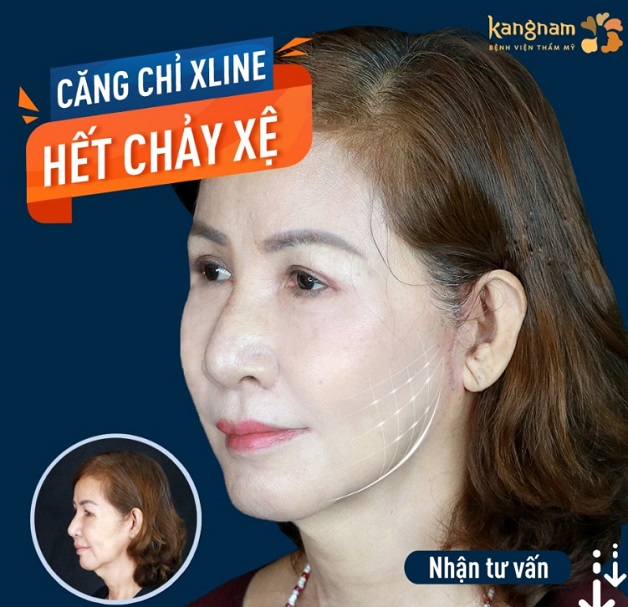 Công nghệ căng chỉ Xline tại Viện Thẩm mỹ Kangnam Đà Nẵng nâng cơ hết chảy xệ trong 1 lần duy nhất