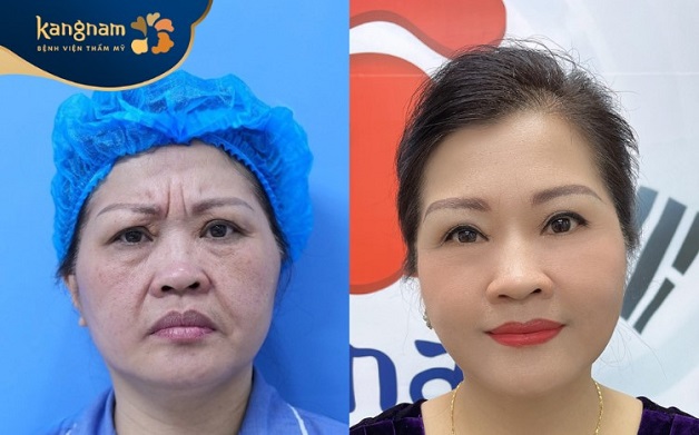 Khách hàng lần đầu tiên trải nghiệm dịch vụ căng da tại Kangnam Đà Nẵng hài lòng với kết quả