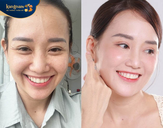 Căng da mặt là dịch vụ được ưa chuộng tại Đà Nẵng