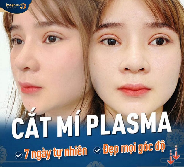 Cắt mí Plasma là phương pháp tạo hình mắt 2 mí Hàn Quốc sử dụng công nghệ Plasma