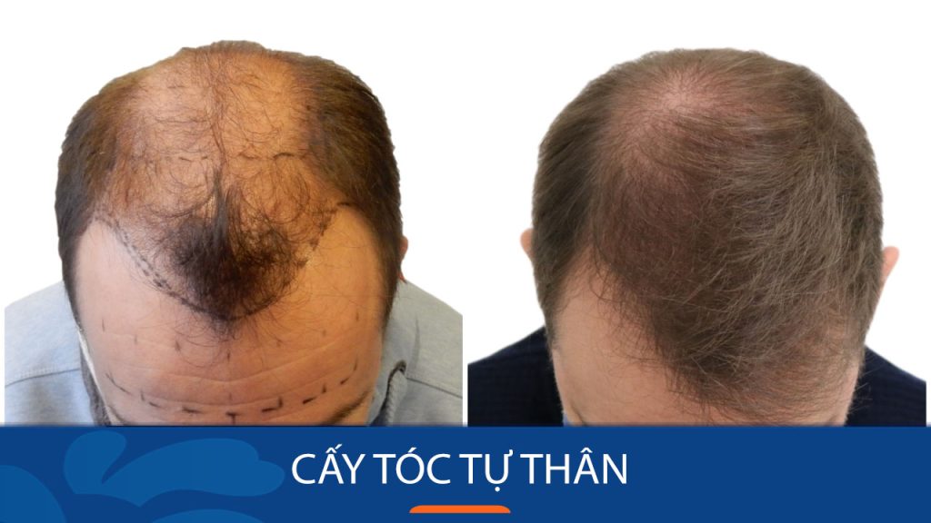 Lợi ích của cấy tóc tự thân: Tự tin trở lại với mái tóc đầy đặn