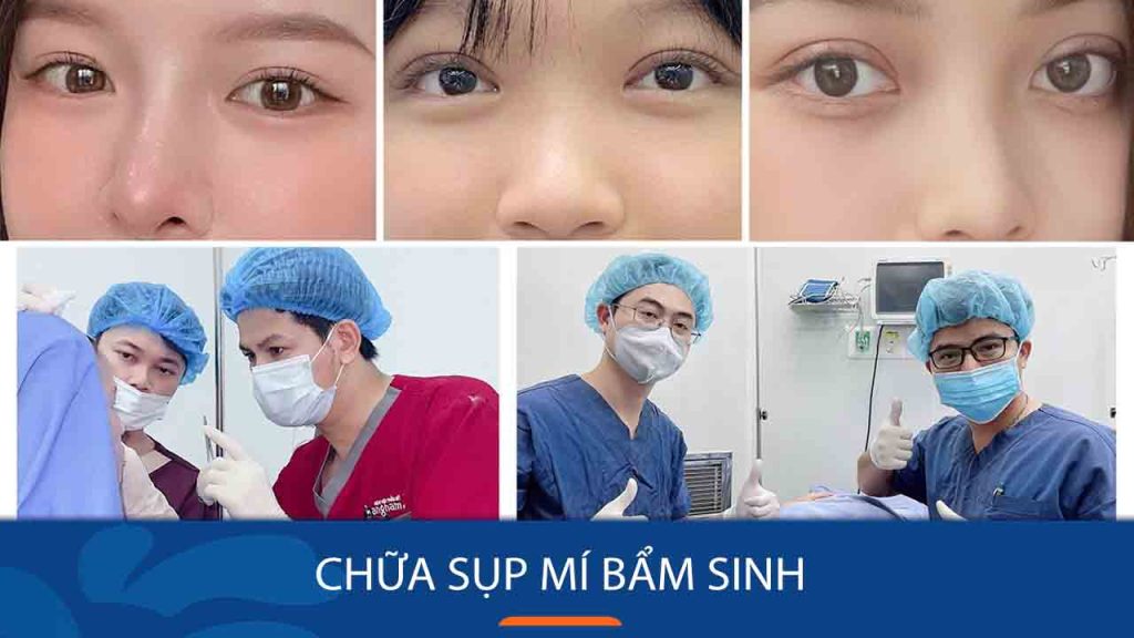 Sụp mí mắt bẩm sinh: Nguyên nhân, biểu hiện và cách khắc phục hiệu quả