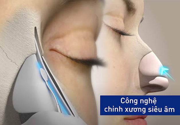 Công nghệ chỉnh xương siêu âm, khắc phục các khuyết điểm về mũi