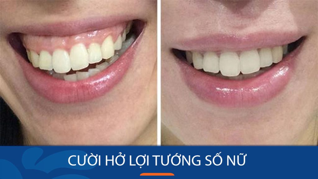 Cười hở lợi tướng số – Giải mã nụ cười “kém duyên”