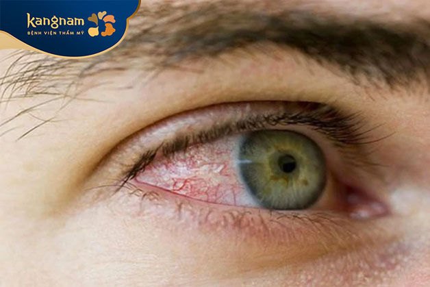 Cảm giác nóng rát và đau mắt cũng có thể xuất hiện khi mắt bị dị ứng