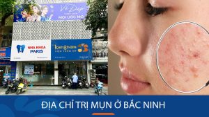 Bật mí địa chỉ trị mụn ở Bắc Ninh hiệu quả – Trị gốc rễ mọi loại mụn