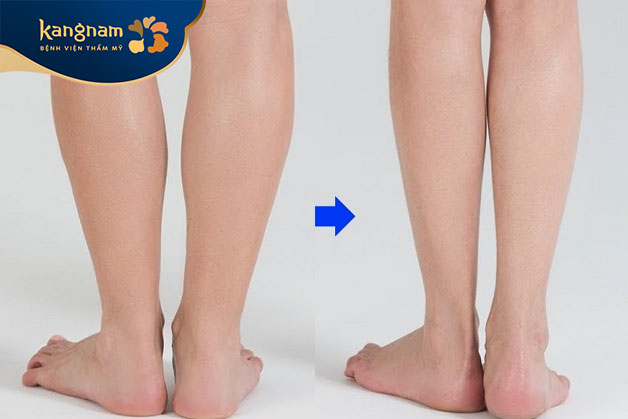Quá trình hút mỡ vùng bắp chân sẽ phân tách lượng mỡ thừa để chuyển thành dạng lỏng trước khi được loại bỏ