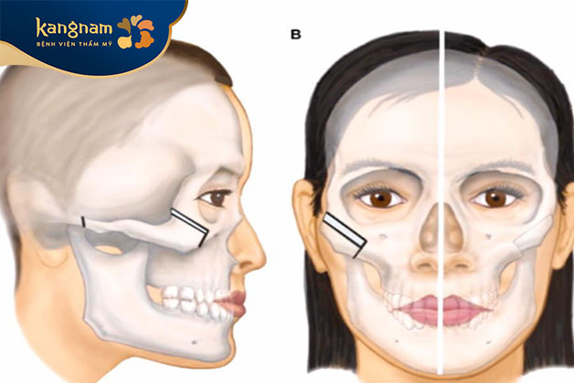 Cấu trúc xương mặt di truyền từ cha mẹ