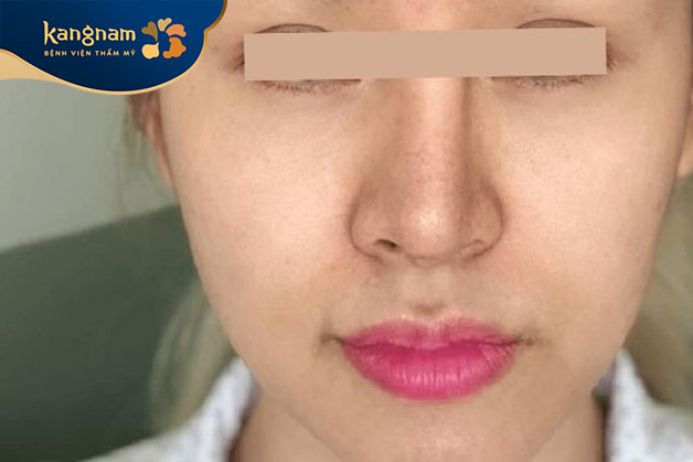 Mũi lệch vẹo cần được khắc phục lại để đảm bảo chức năng và tính thẩm mỹ vùng mũi