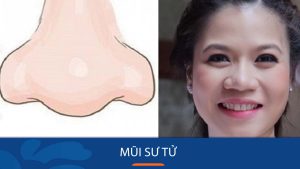 Mũi sư tử (mũi lân) là gì? Có nên sửa không?