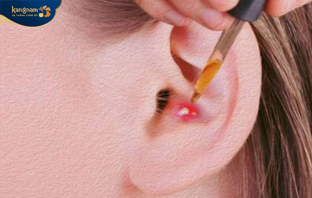 Laser là một trong những phương pháp điều trị mụn bọc ở tai hiệu quả