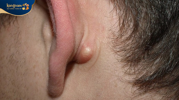 Mụn bọc ở tai có thể do cách vệ sinh tai chưa đúng
