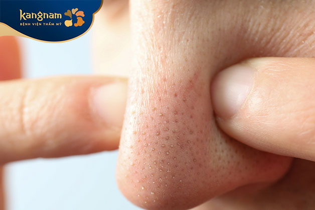 không nên nặn mụn cám trên mũi vì có thể gây tổn thương cho da