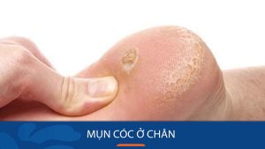 Mụn cóc ở chân: Đánh bay vĩnh viễn với bí quyết đơn giản