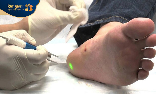 Điều trị mụn cóc bằng laser là cách tốt nhất để triệt tiêu toàn bộ chân mụn, trị dứt điểm